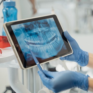 dental digital x-rays