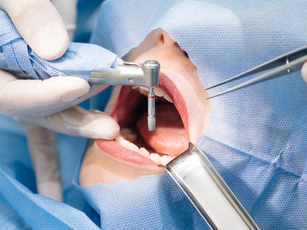 Installing Dental Implants