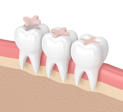 dental sealants