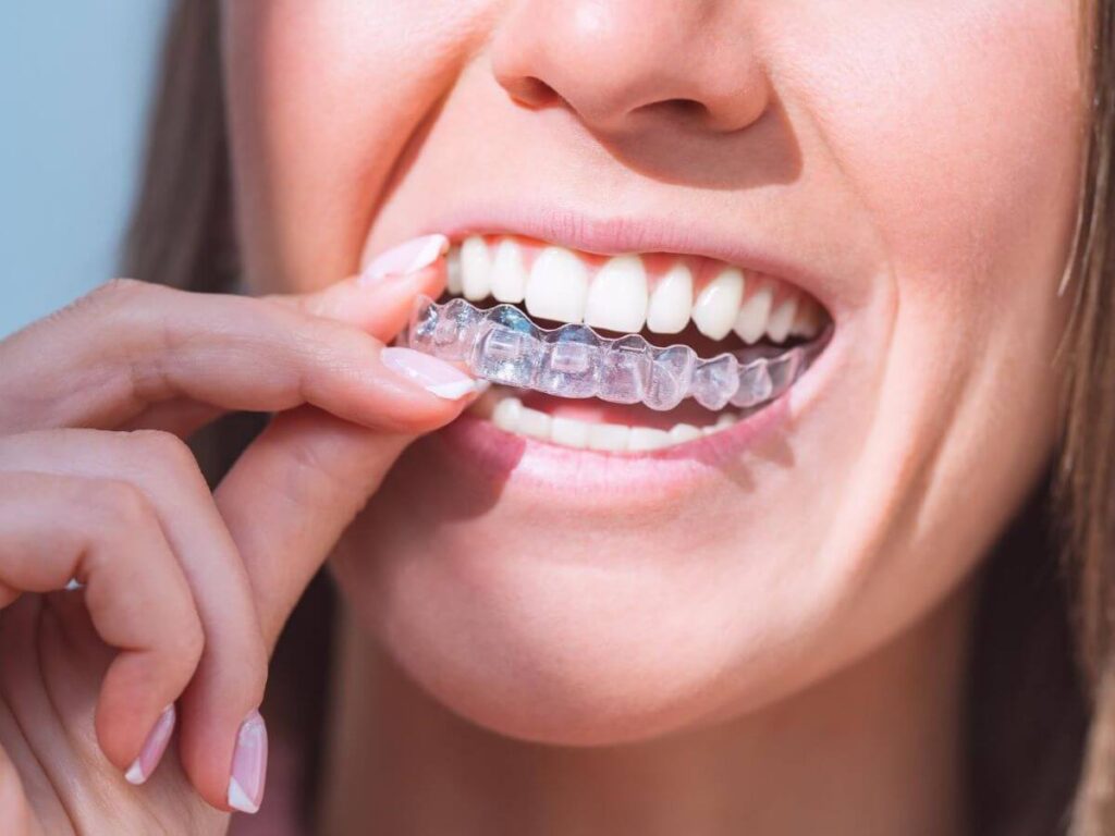Things You Should Know About Invisalign